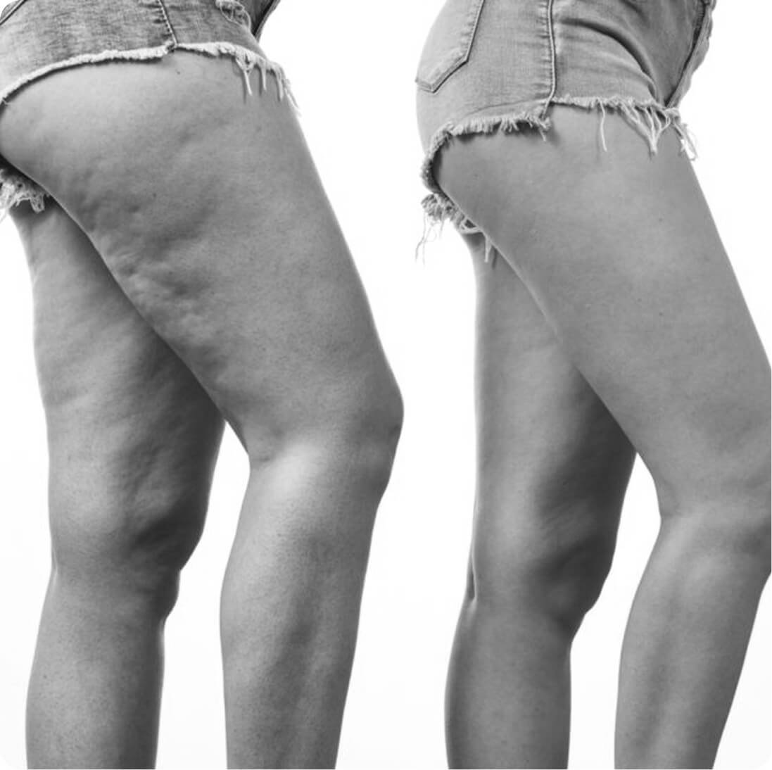 Thigh lift result
