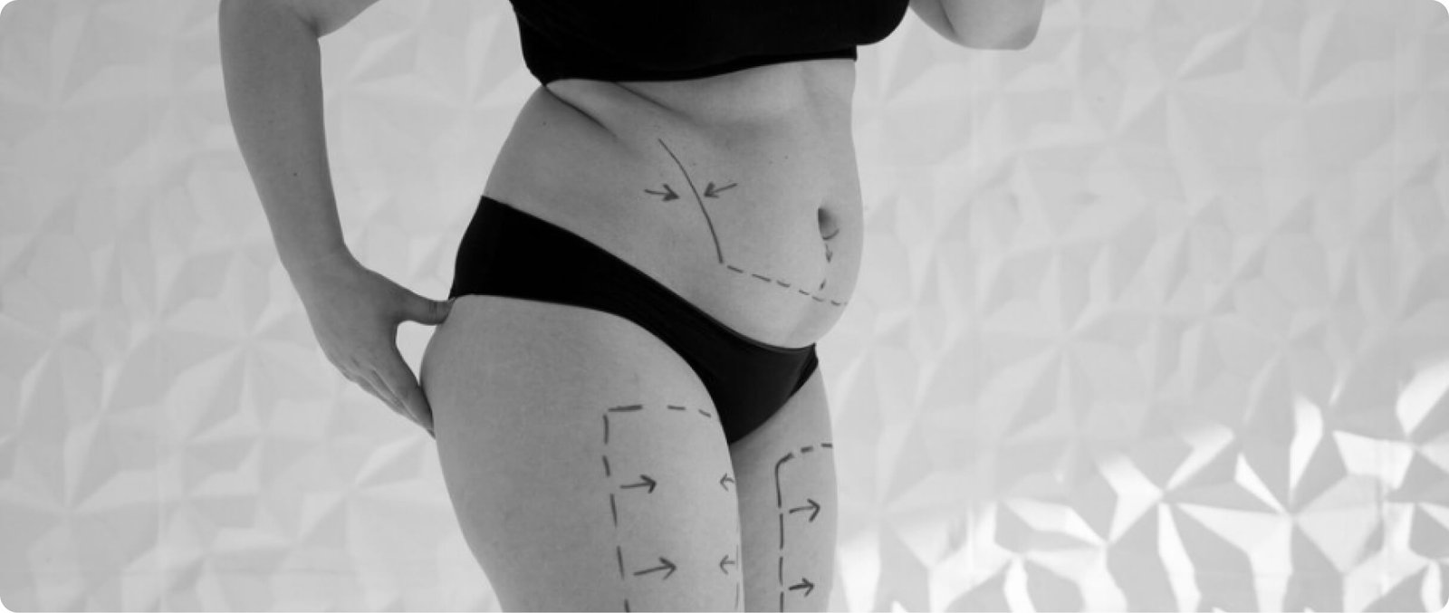 Total body contouring