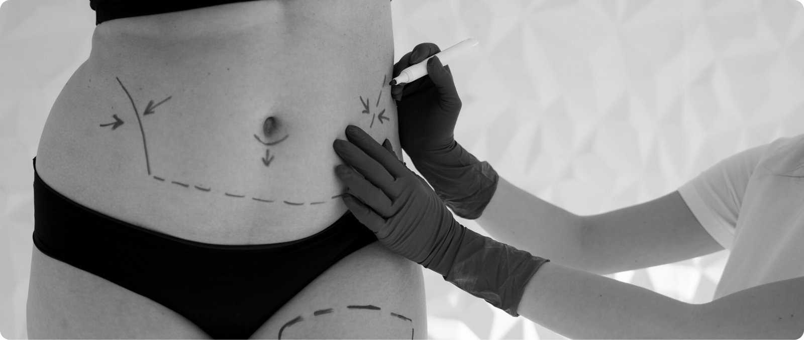 Tummy tuck abdominoplasty