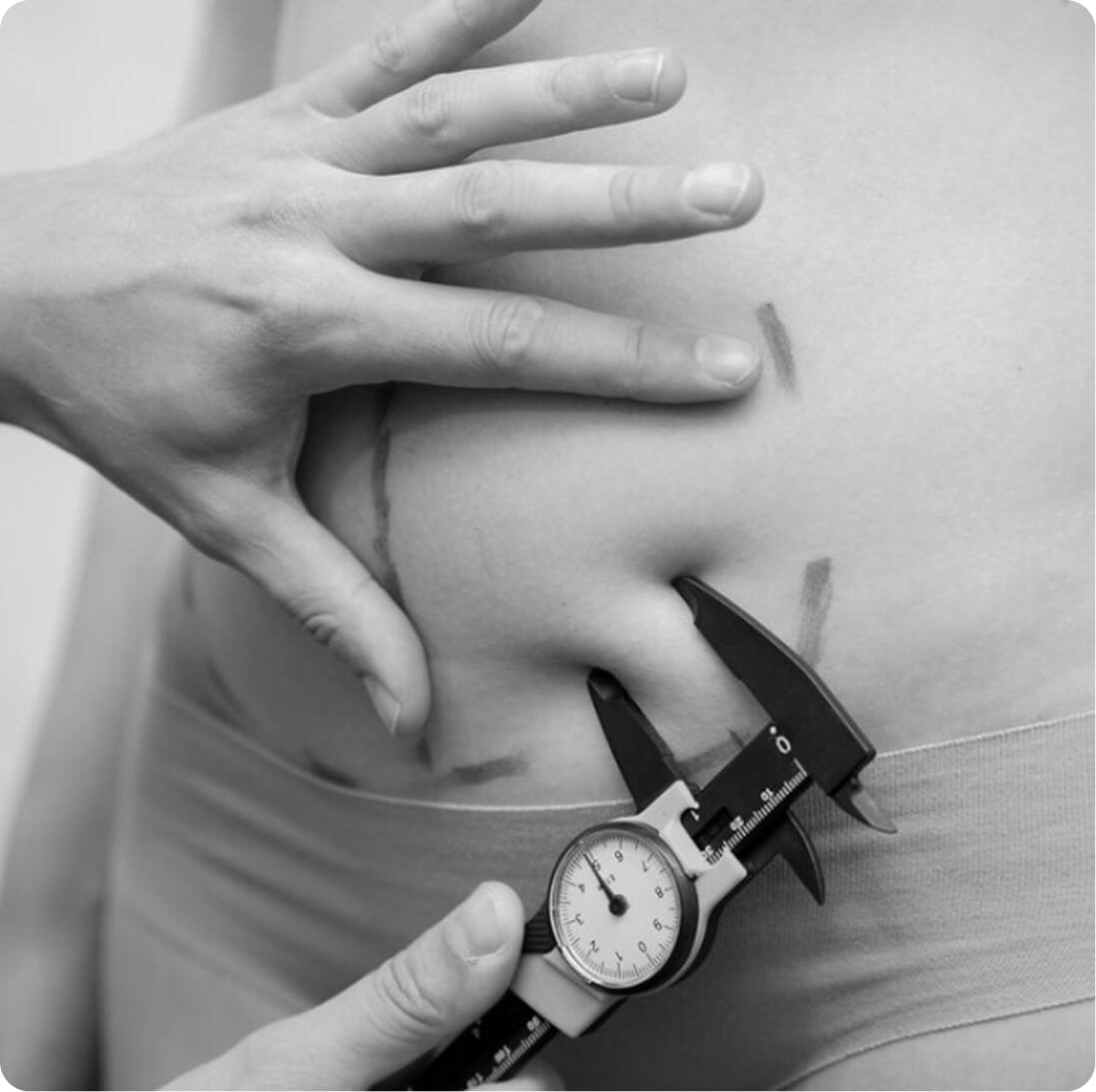 Tummy tuck result