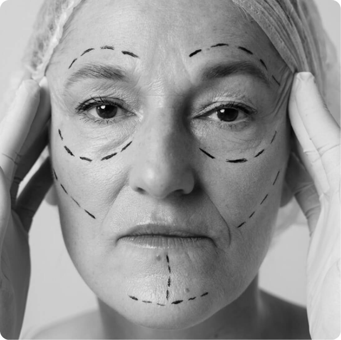 Facelift result